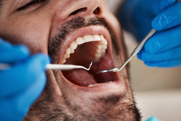 Best Emergency Tooth Extraction in Mcminnville, TN